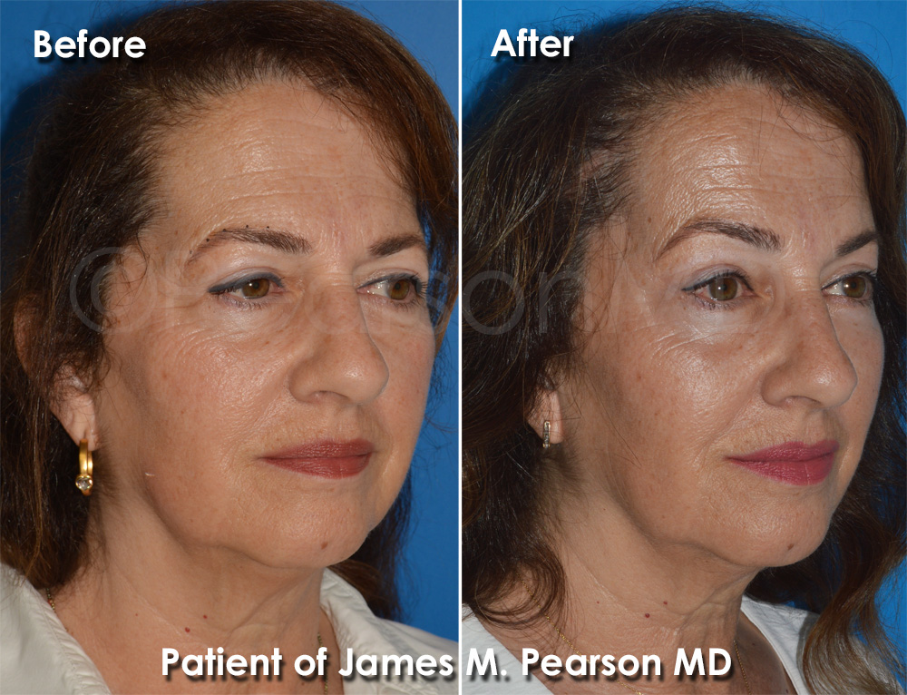 Brow Lift Dr. Pearson