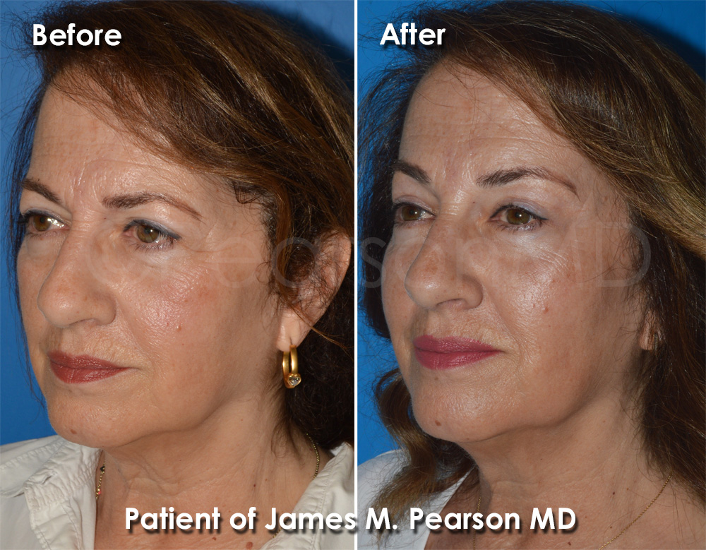 Brow Lift Pearson Plastic Surgery