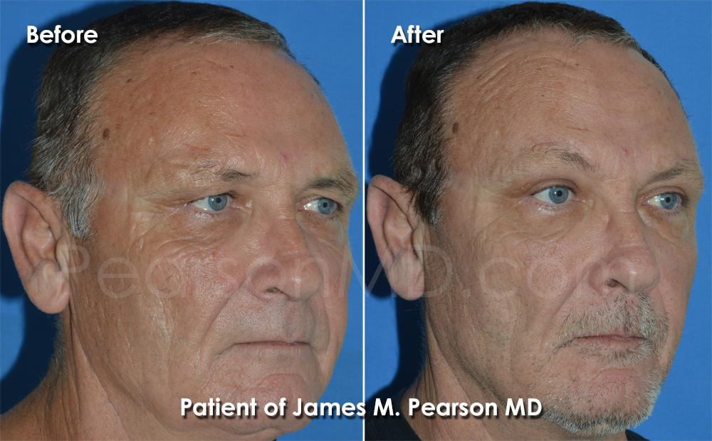 Dr. Pearson Browlift Photo