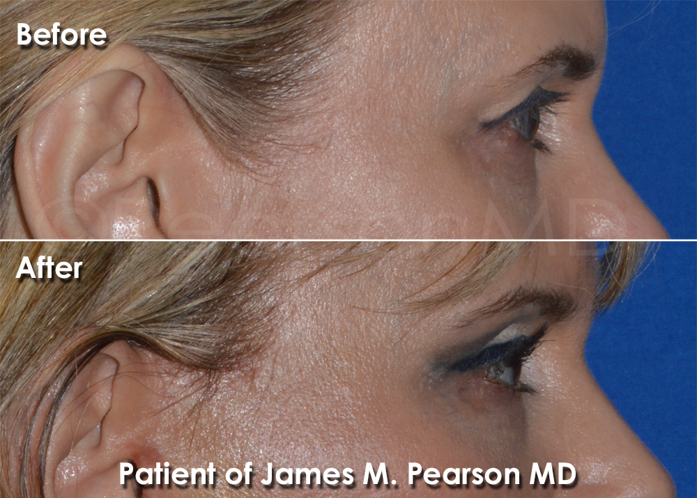 Dr. Pearson Browlift Photo