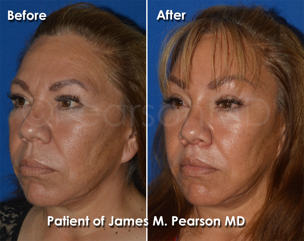 Pearson Plastic Surgery