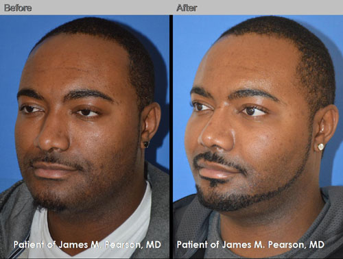 Photos - Cheek Implant - Dr. James Pearson Facial Plastic Surgery