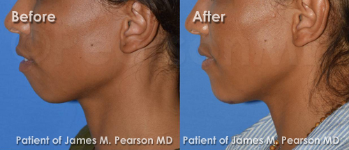 Photo Pearson Chin Implant Before and After