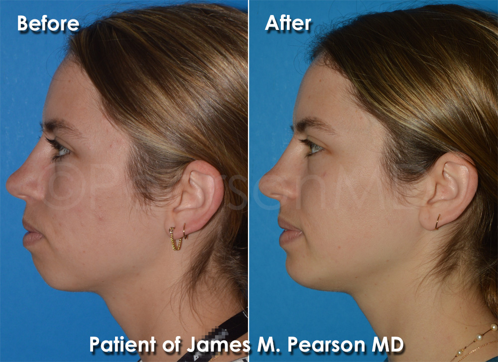 Dr. Pearson Chin Implant Photos