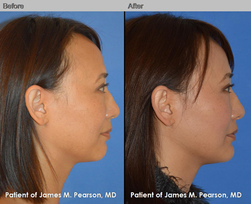 Dr. Pearson Chin Implant Photo