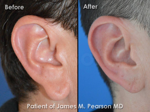Photos Pearson Earlobe Reduction