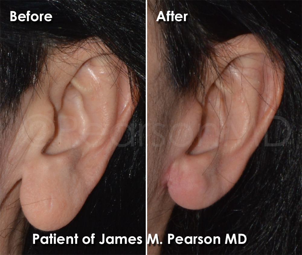 Earlobe Reduction Photos