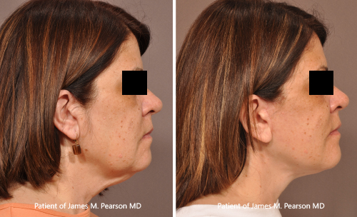 Photos Pearson Facelift
