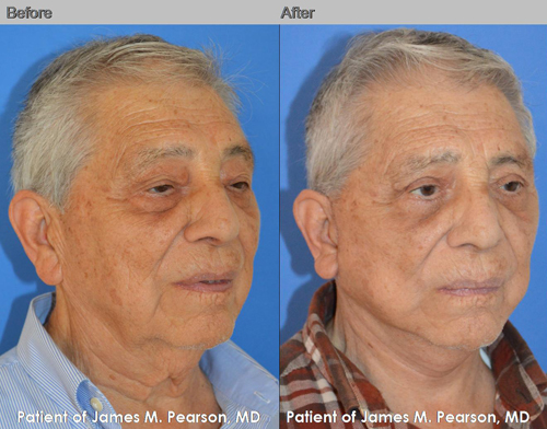 Dr. Pearson Male Facelift Photo