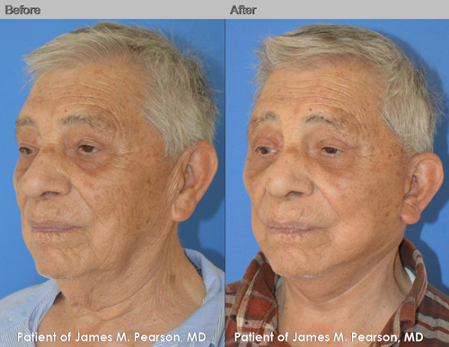 Dr. Pearson Male Facelift & Neck Lift Photo