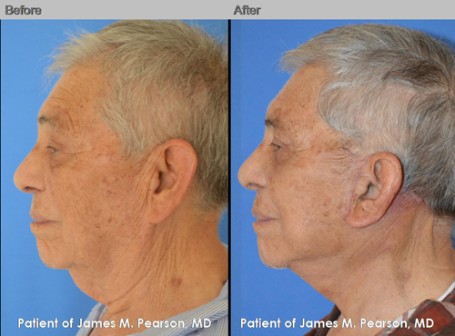 Dr. Pearson Male Neck Lift Photo