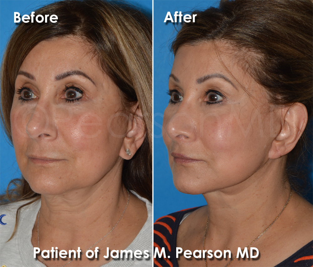 Dr. Pearson Facelift Surgery