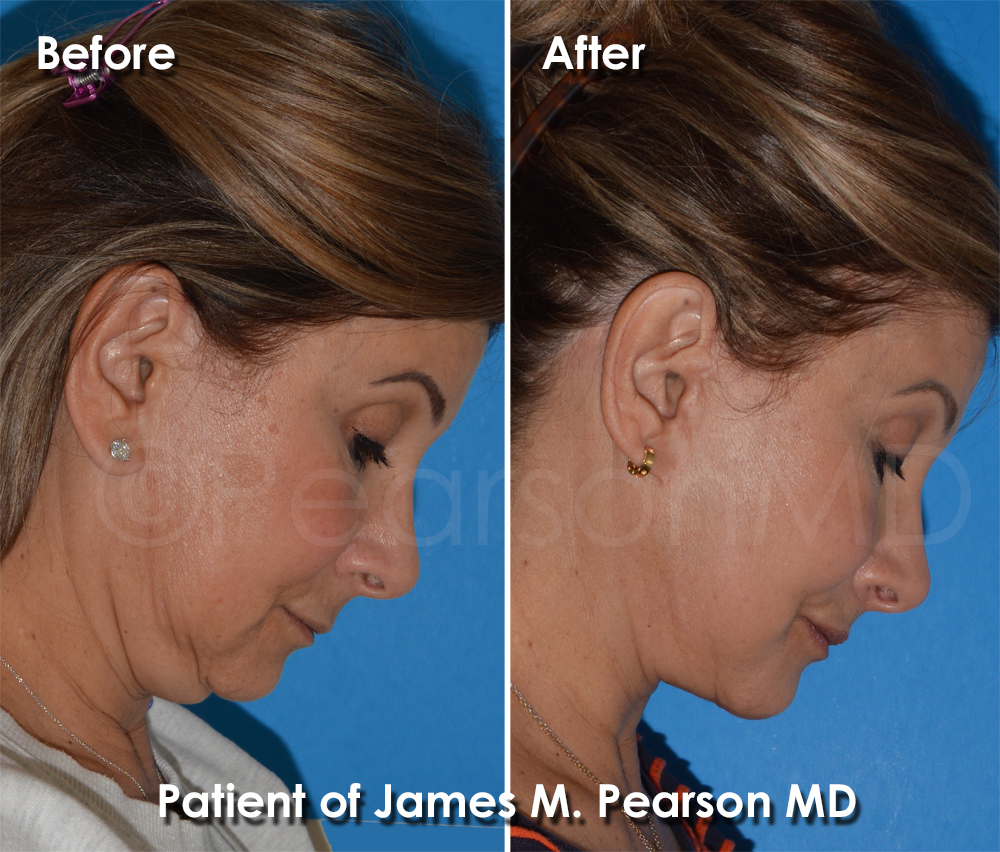 Dr. Pearson Facelift Surgery