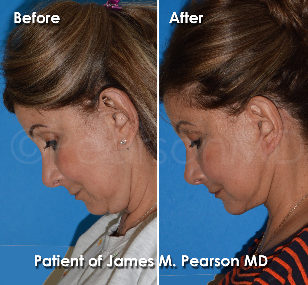 Dr. Pearson Facelift Surgery