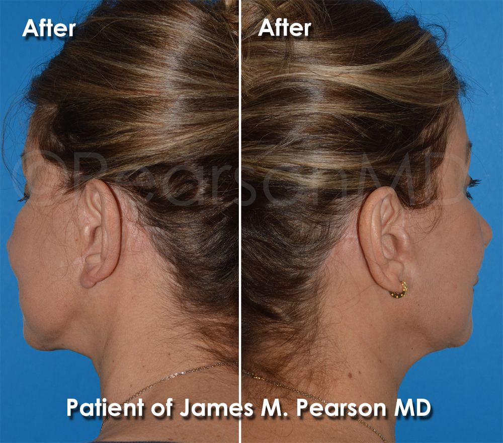 Dr. Pearson Facelift Surgery