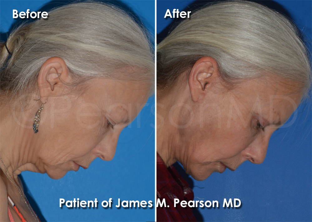 Dr. Pearson Facelift Surgery