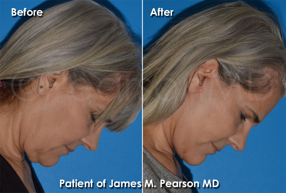 Dr. Pearson Facelift Surgery