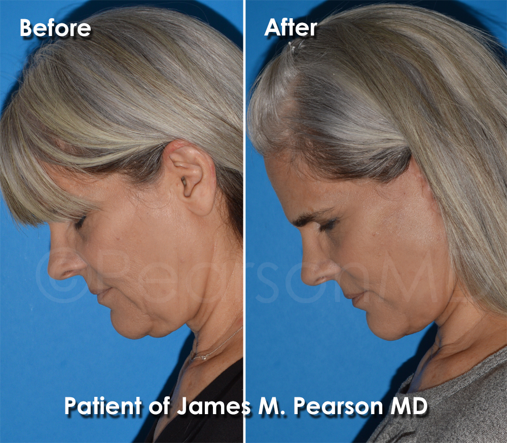 Dr. Pearson Facelift Surgery