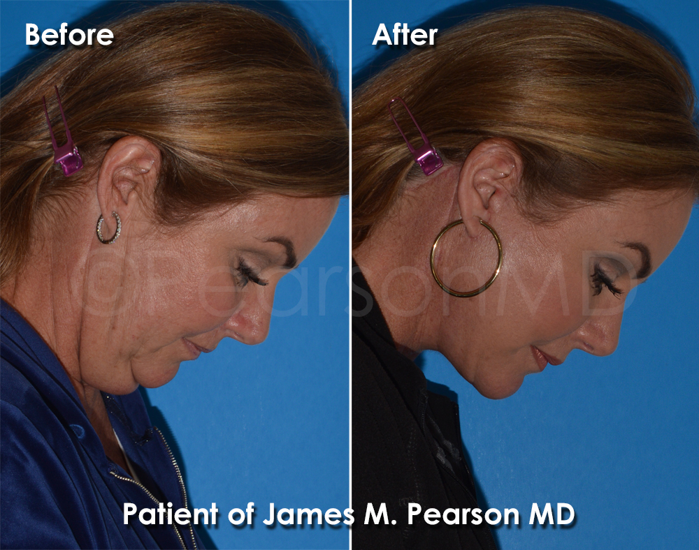 Pearson Plastic Surgery