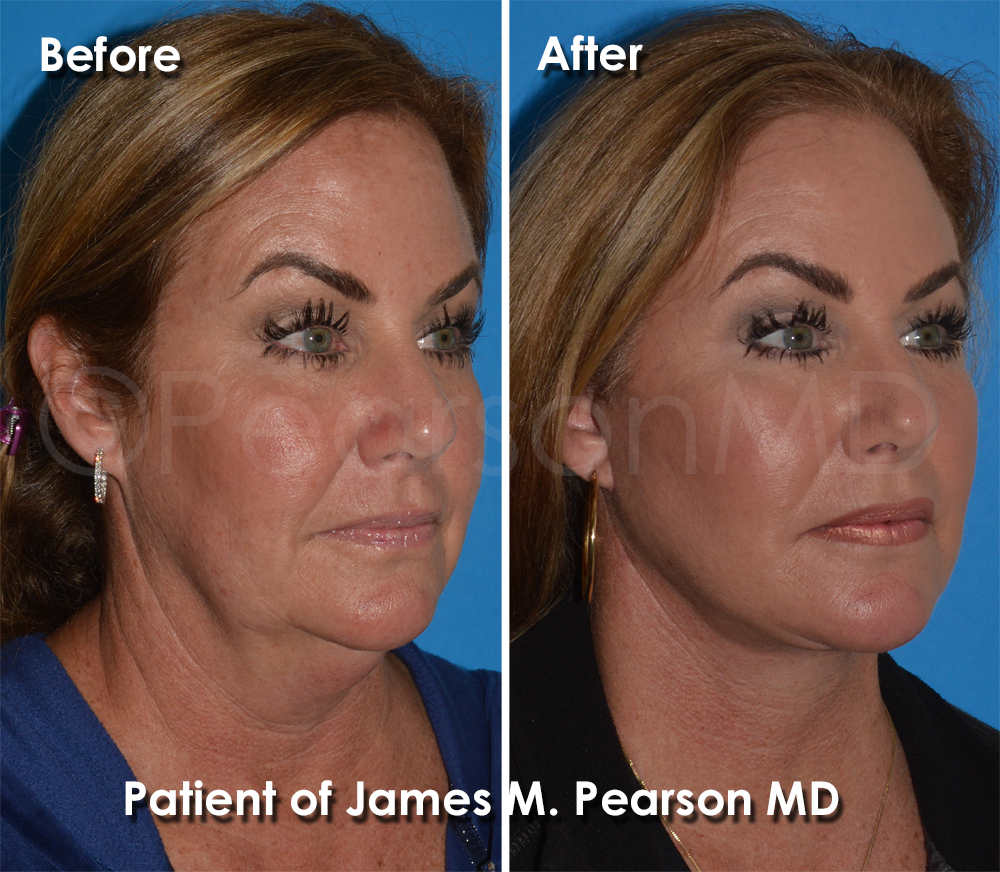 Dr. Pearson Facelift Surgery