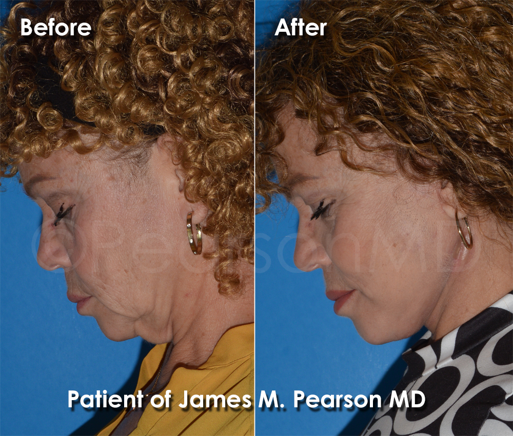 Dr. Pearson Facelift Surgery