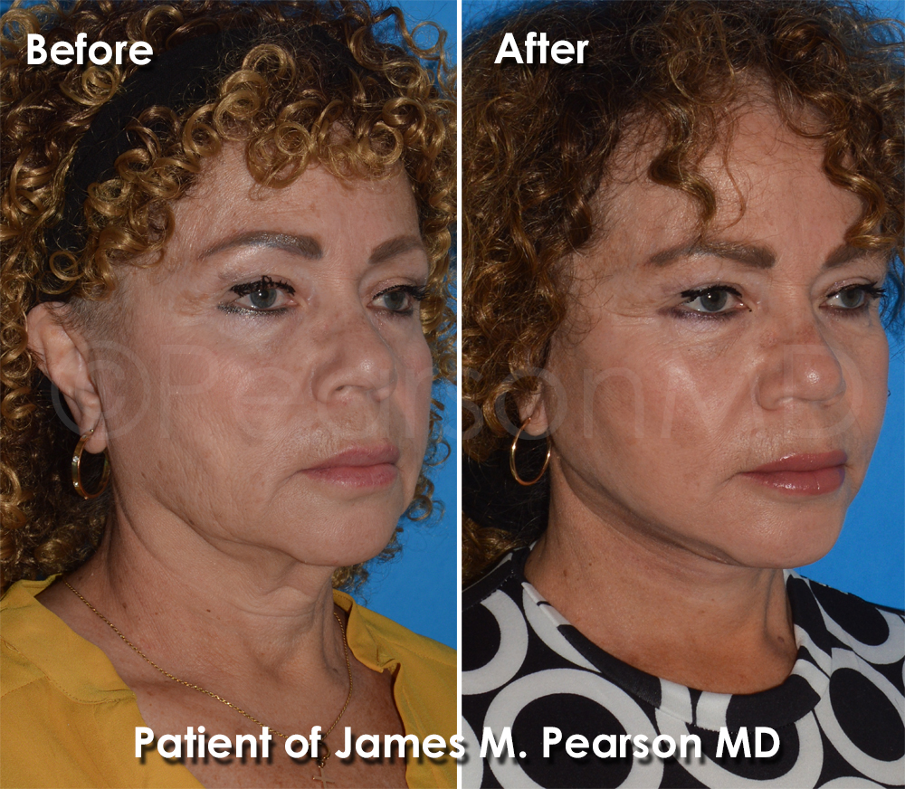 Dr. Pearson Facelift Surgery
