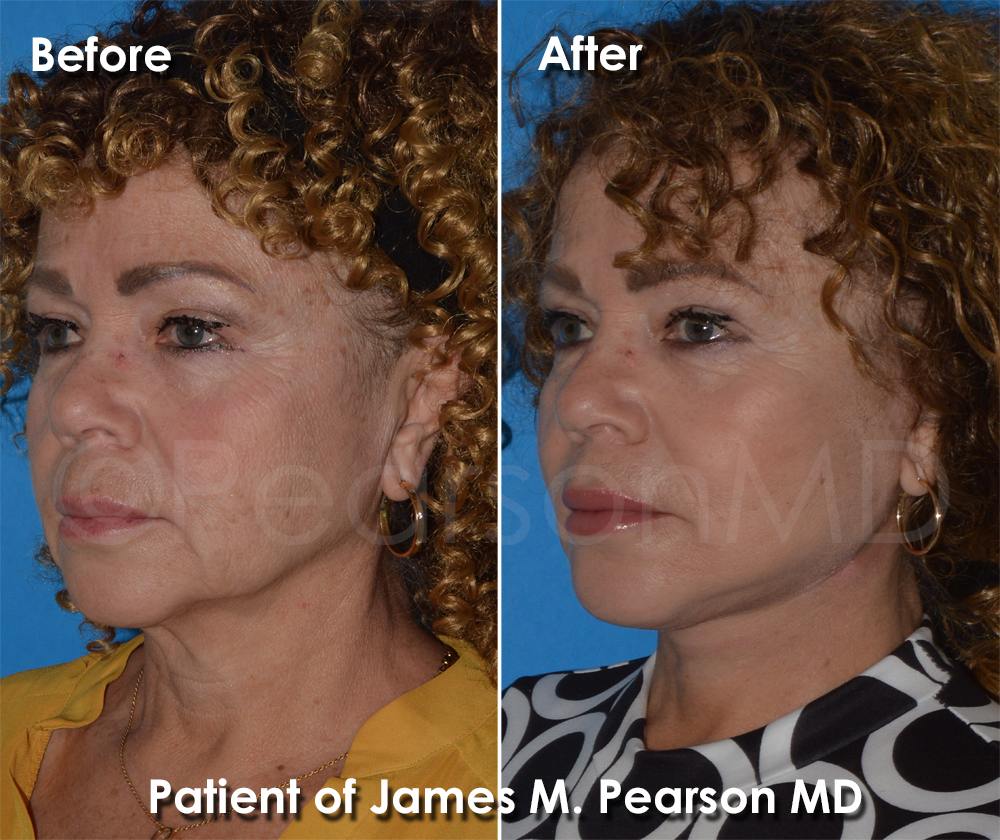 Dr. Pearson Facelift Surgery