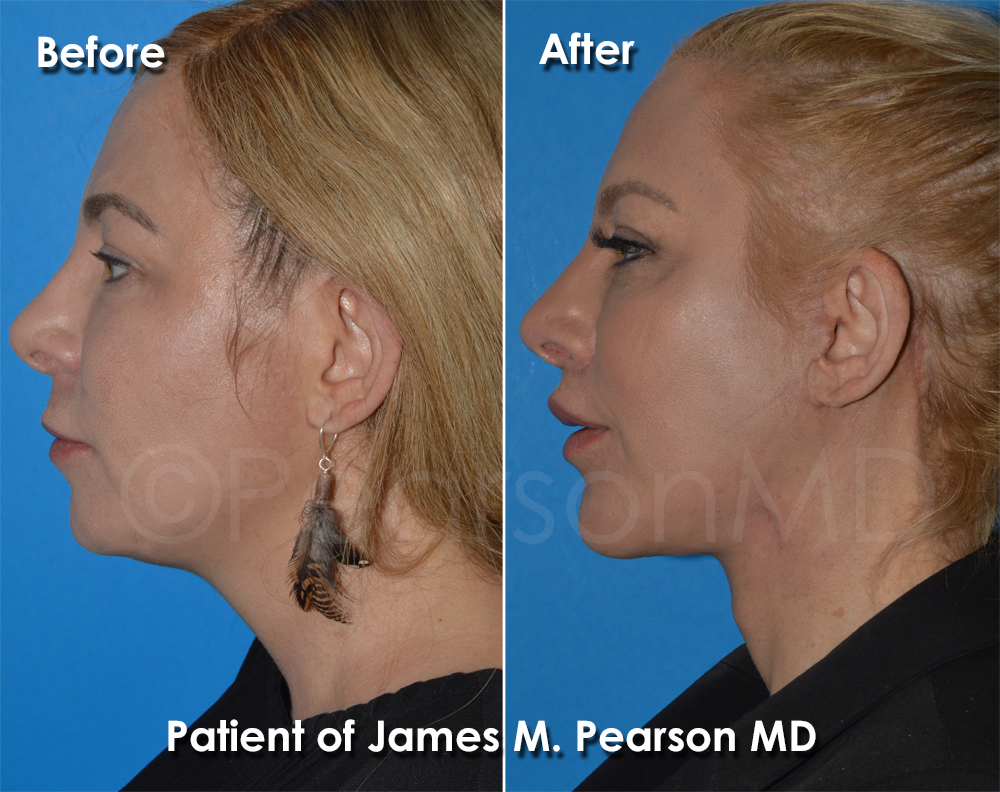 Pearson Plastic Surgery