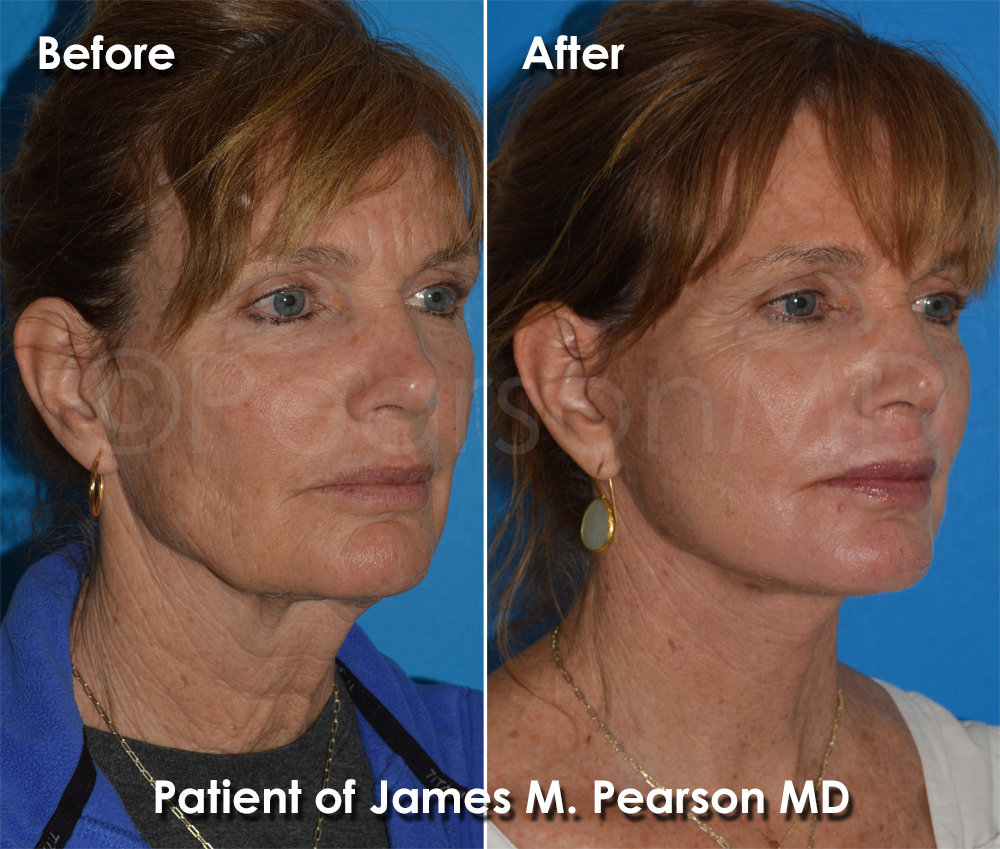 Dr. Pearson Plastic Surgeon