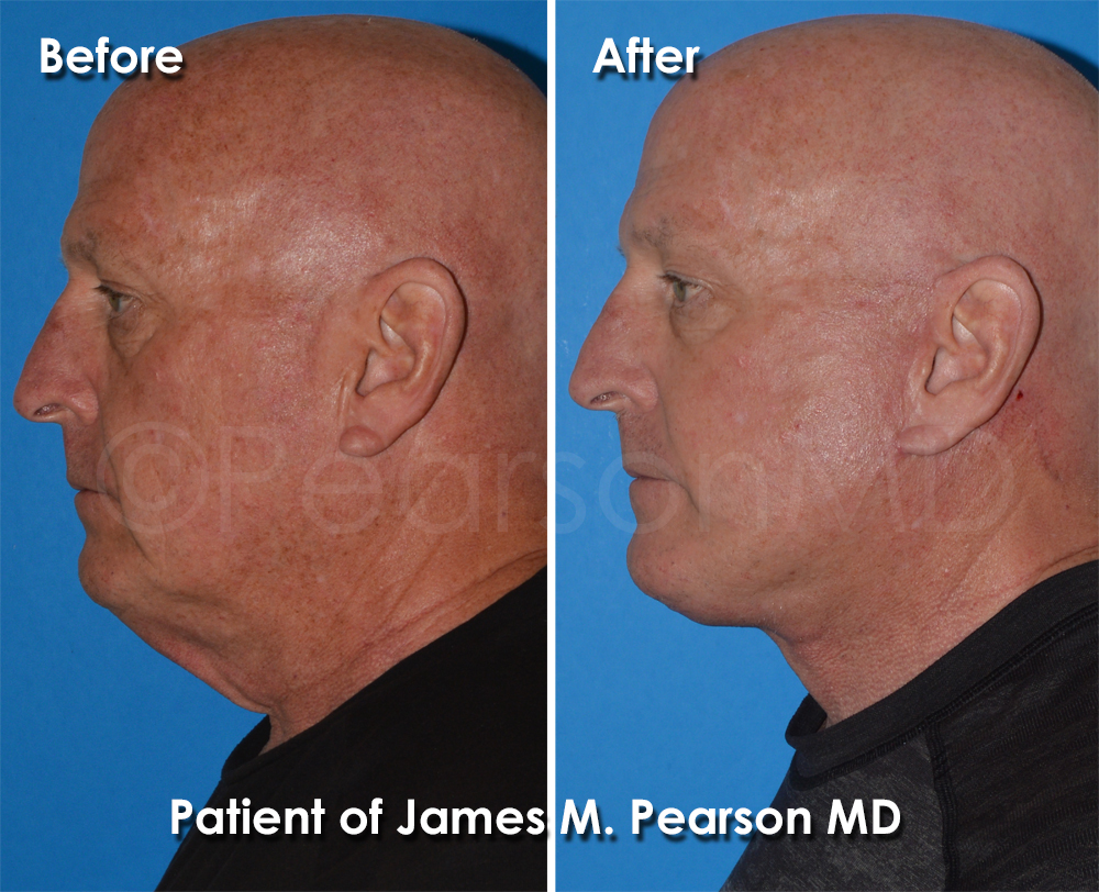 Dr. Pearson Plastic Surgeon