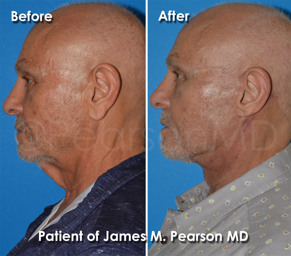 Pearson Plastic Surgery