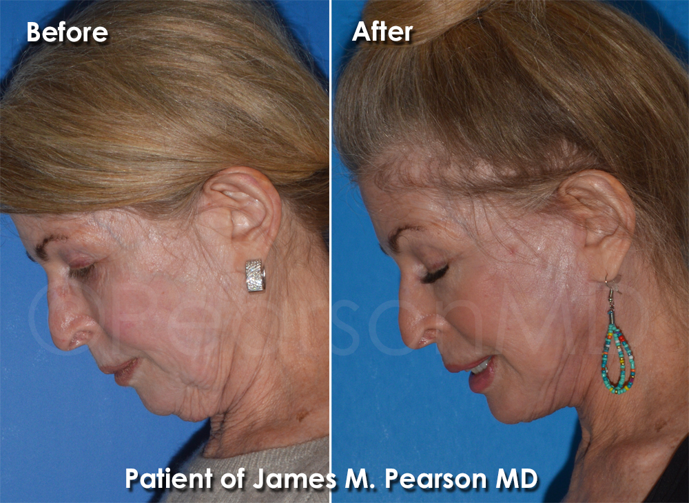 Dr. Pearson Plastic Surgeon