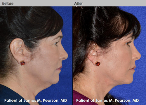 Dr. Pearson Male Neck Lift Photo