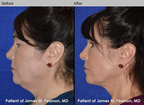 Dr. Pearson Male Neck Lift Photo