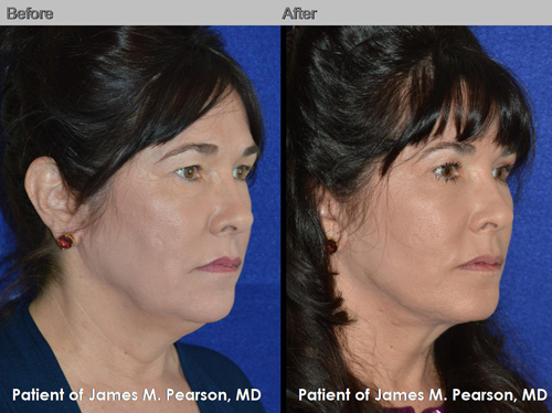 Dr. Pearson Male Neck Lift Photo