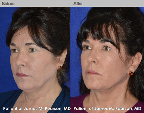 Dr. Pearson Male Neck Lift Photo
