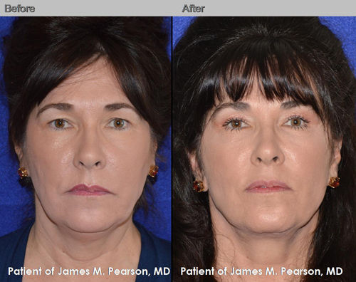 Dr. Pearson Male Neck Lift Photo