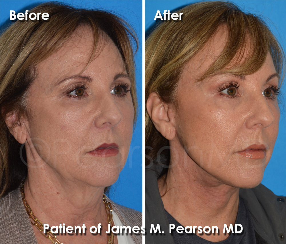 Pearson Plastic Surgery