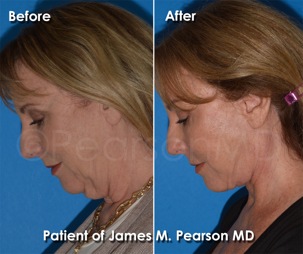 Dr. Pearson Plastic Surgeon