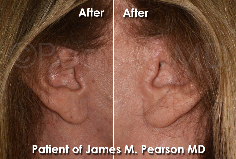 Dr. Pearson Plastic Surgeon
