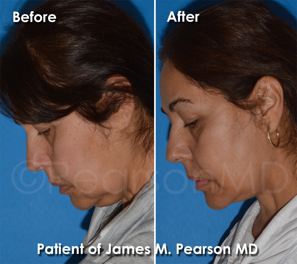 Pearson Plastic Surgery