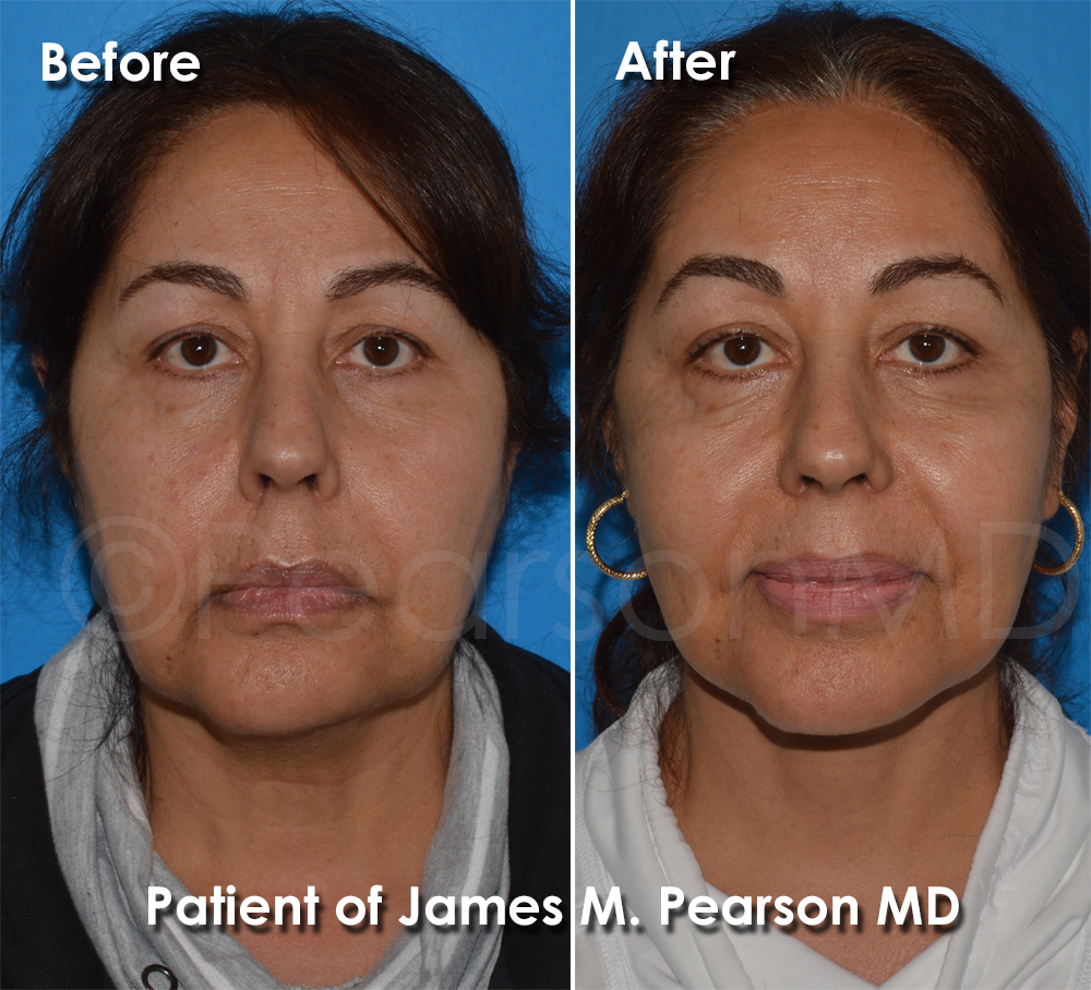 Pearson Plastic Surgery
