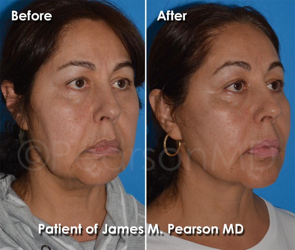 Dr. Pearson Plastic Surgeon