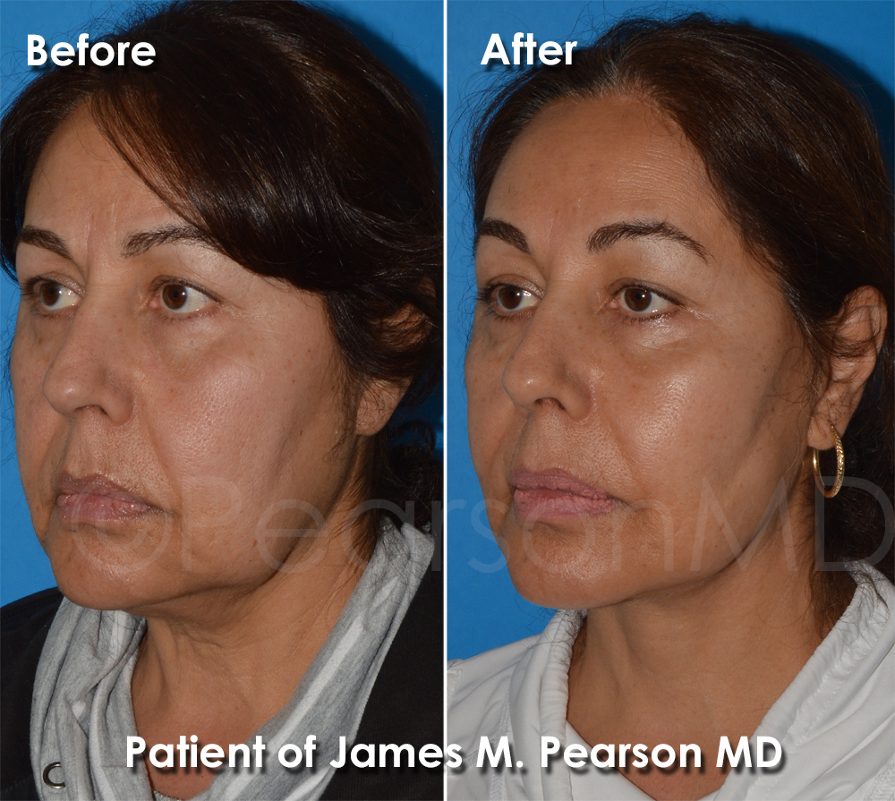 Dr. Pearson Plastic Surgeon