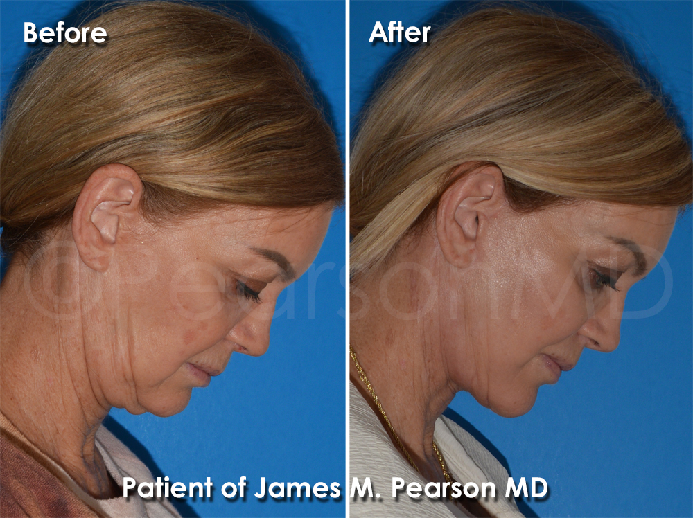 Pearson Plastic Surgery