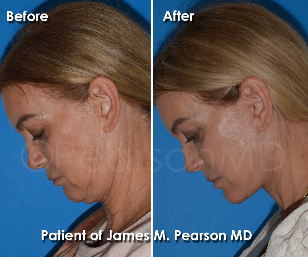 Pearson Plastic Surgery