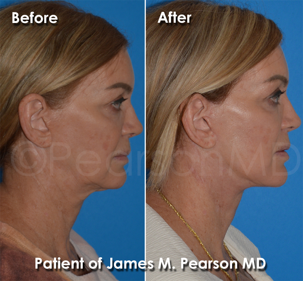 Dr. Pearson Plastic Surgeon
