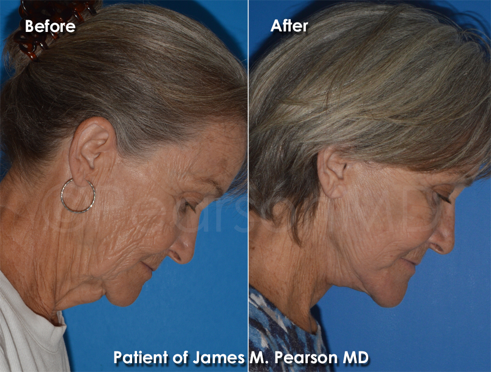 Dr. Pearson Plastic Surgeon