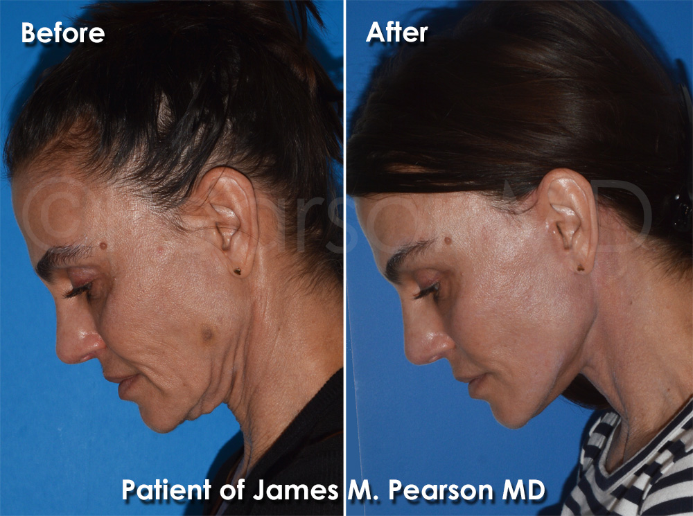 Pearson Plastic Surgery