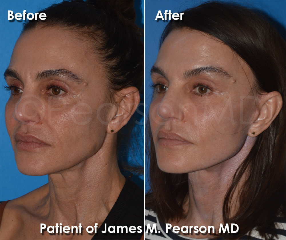Pearson Plastic Surgery